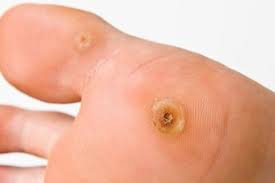 best wart removal clinic in bhubaneswar near by apollo hospital